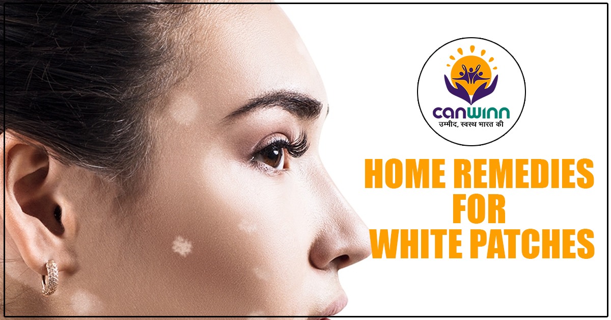 Hindi white in on face treatment at spots home Home Remedies
