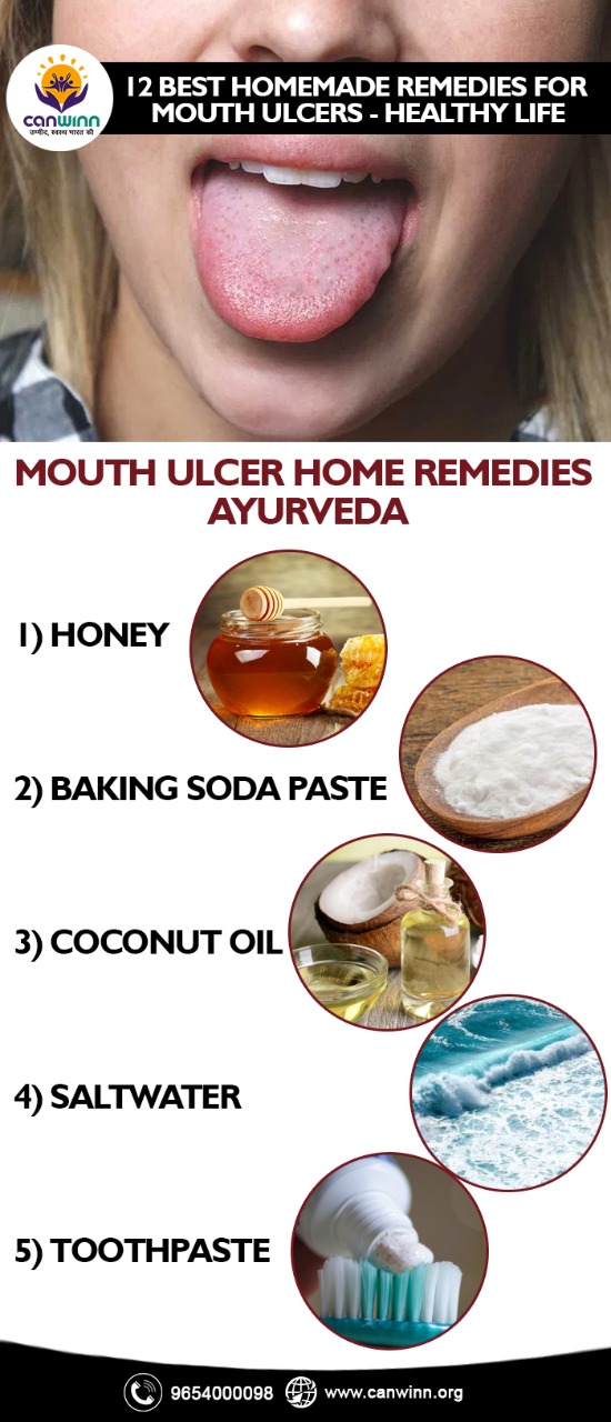 best homemade remedies for mouth ulcers