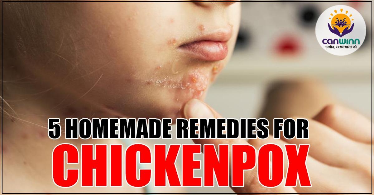 5 homemade remedies for chickenpox- Canwinn Foundation