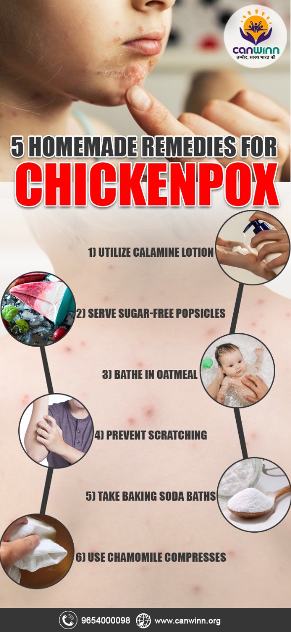 5 homemade remedies for chickenpox- Canwinn Foundation